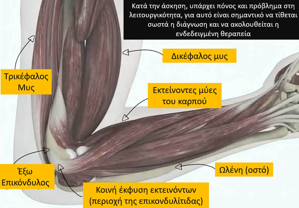 Επικονδυλίτιδα αγκώνα ανατομία αγκώνα του τενίστα ανατομία περιοχή της επικονδυλίτιδας έξω επικόνδυλος