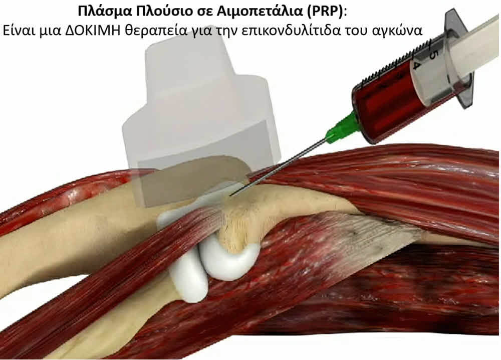Βιολογική θεραπεία επικονδυλίτιδας αγκώνα καινοτόμα και αποτελεσματική θεραπεία για τον αγκώνα του τενίστα