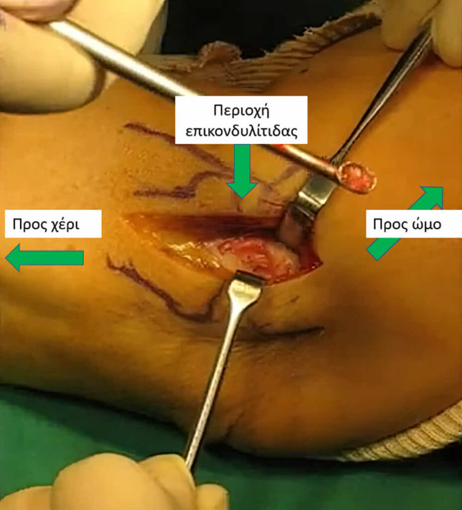 Επικονδυλίτιδα αγκώνα αγκώνας του τενίστα χειρουργική αντιμετώπιση χειρουργείο