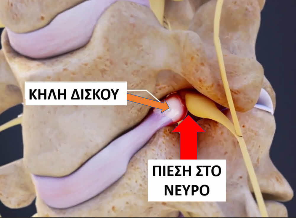 Κήλη δίσκου αυχενικής μοίρας σπονδυλικής στήλης που προκαλεί αυχεναλγία και αυχενικό σύνδρομο κήλη στον αυχένα