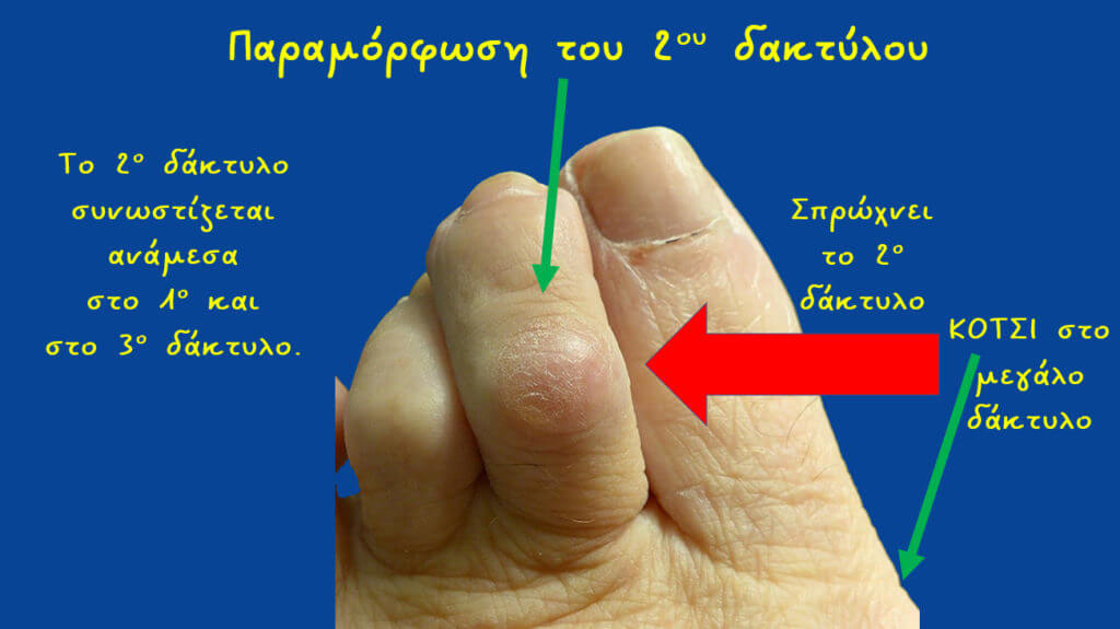 Το κότσι στο πόδι σπρώχνει το δεύτερο δάχτυλο προς την κατεύθυνση των υπολοίπων δακτύλων. 