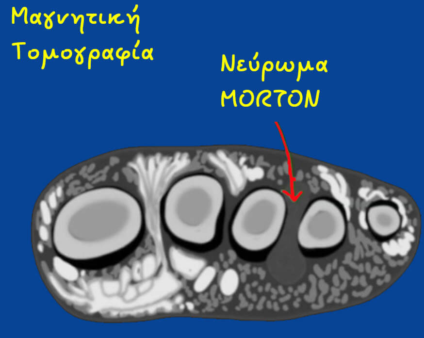 Νεύρωμα Morton - Διάγνωση