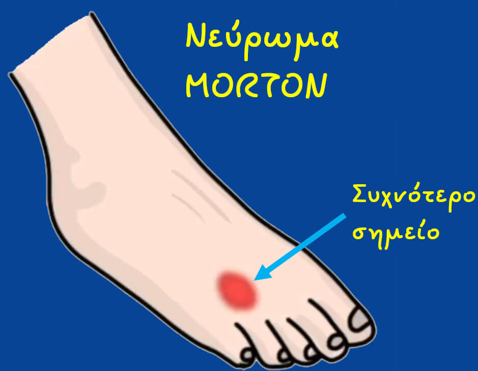 Νεύρωμα Morton: η συχνότερη εντόπιση του είναι ανάμεσα στο τρίτο και τέταρτο δάχτυλο.