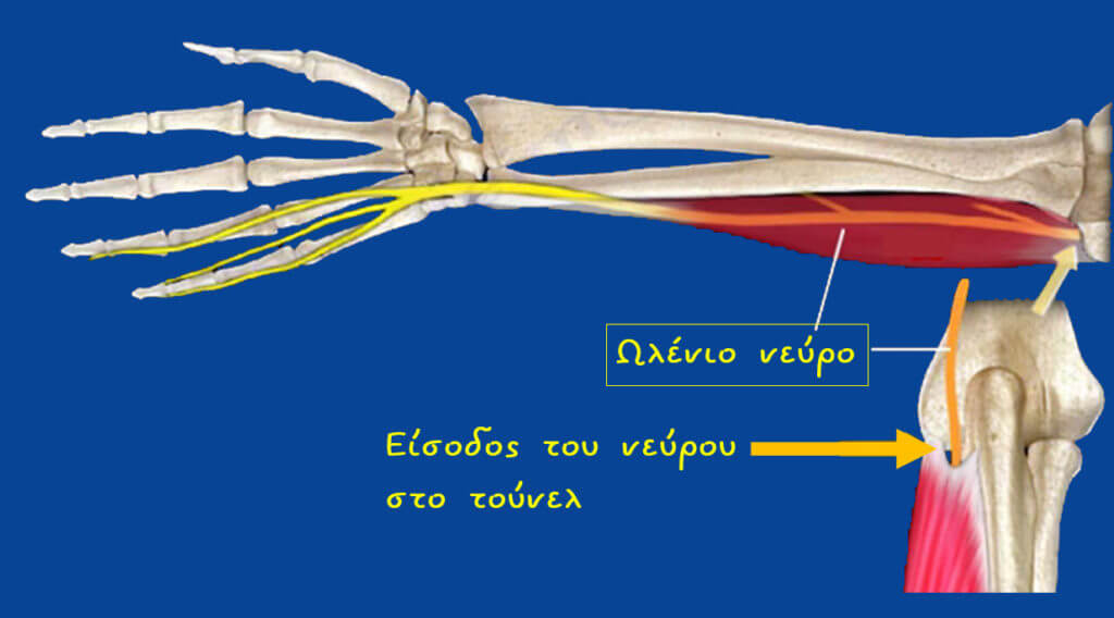  Η σήραγγα ιστού (τούνελ) μέσα από την οποία περνάει το νεύρο σχηματίζεται από το κόκκαλο καθώς και από έναν μυ. Εδώ βλέπουμε το νεύρο να εισέρχεται στην είσοδο του τούνελ.