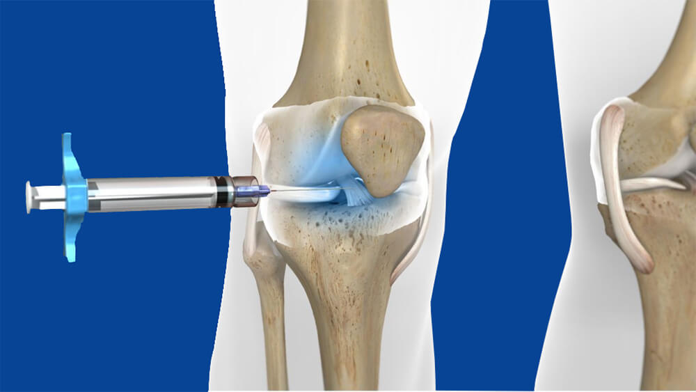 Η έγχυση με υαλουρονικό οξύ στο γόνατο είναι τελείως ανώδυνη και γίνεται υπό άσηπτες συνθήκες στο ιατρείο. Εδώ βλέπουμε μία βελόνα να εισέρχεται στο γόνατο και να εγχύει υαλουρονικό οξύ.