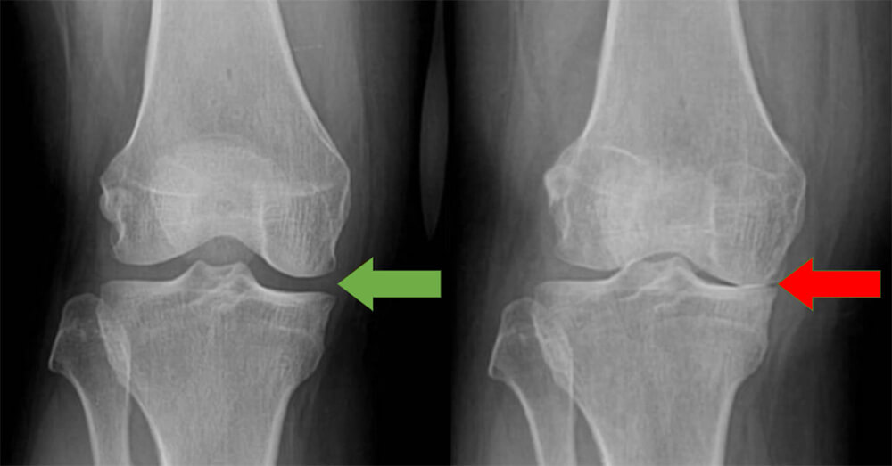 Ακτινογραφία γόνατος σε όρθια θέση που δείχνει ένα φυσιολογικό γόνατο, καθώς και ακτινογραφία γόνατος σε όρθια θέση που δείχνει ένα γόνατο με αρθρίτιδα (οστεοαρθρίτιδα γόνατος)