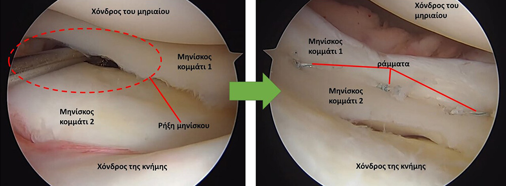 Διεγχειρητική εικόνα Αρθροσκόπηση γόνατος που δείχνει μία αρθροσκοπική εικόνα με μία ρήξη μηνίσκου η οποία αντιμετωπίζεται με αρθροσκοπική συρραφή