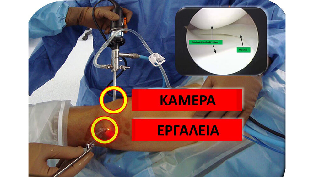 Εικόνα που δείχνει χειρουργείο αρθροσκόπησης γόνατος και περιλαμβάνει μία αρθροσκοπική κάμερα δηλαδή ένα αρθροσκοπικο καθώς και ένα αρθροσκοπικο εργαλείο
