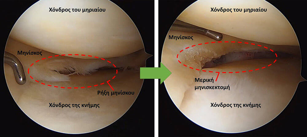 Διεγχειρητική εικόνα Αρθροσκόπηση γόνατος που δείχνει μία αρθροσκοπική εικόνα με μία εκφυλιστική ρήξη μηνίσκου η οποία αντιμετωπίζεται με μερική μηνισκεκτομή