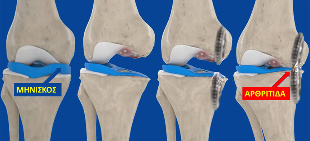 Όταν υπάρχει βλάβη μηνίσκου το γόνατο παθαίνει αρθρίτιδα που ονομάζουμε αλλιώς και οστεοαρθρίτιδα γόνατος.