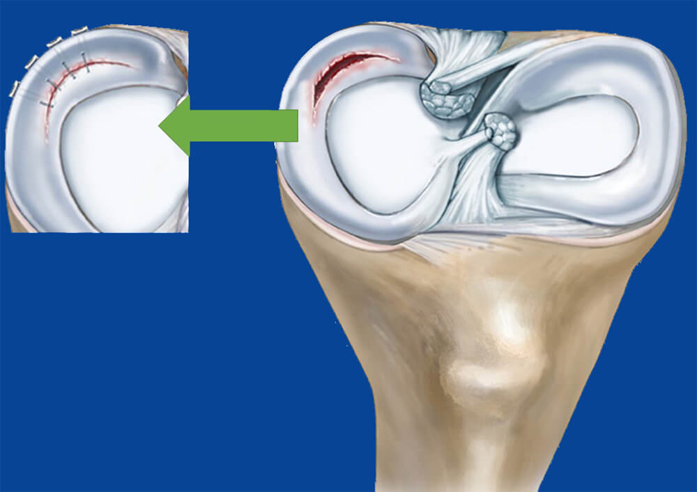 Σχήμα αναπαράστασης αρθροσκόπηση γόνατος με ρήξη μηνίσκου που αντιμετωπίζεται χειρουργικά με αρθροσκοπική συρραφή