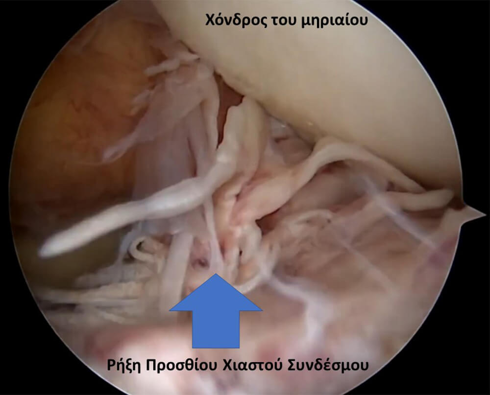 Διεγχειρητική εικόνα Αρθροσκόπηση γόνατος που δείχνει μία αρθροσκοπική εικόνα με μία ρήξη πρόσθιου χιαστού συνδέσμου