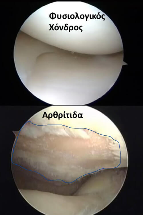 Αρθροσκοπική εικόνα αρθροσκόπησης γόνατος που δείχνει πως φαίνεται αρθροσκοπικά ο φυσιολογικός χόνδρος και πώς φαίνεται αρθροσκοπικά η αρθρίτιδα στο γόνατο