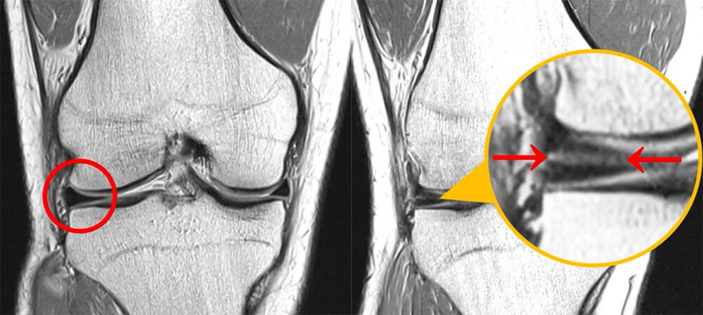 Ακτινογραφία γόνατος: Αριστερά, φυσιολογικό γόνατο. Δεξιά, γόνατο με αρθρίτιδα. Το "κενό" που βλέπουμε ανάμεσα στα οστά, δεν είναι κενό, αλλά ο αρθρικός χόνδρος που δεν φαίνεται στην ακτινογραφία. Όταν στην ακτινογραφία, το κενό "εξαφανίζεται", σημαίνει ότι έχει εξαφανιστεί ο χόνδρος, και φυσικά και ο μηνίσκος. Για να διαπιστωθεί αυτό καλύτερα, πρέπει η ακτινογραφία να βγαίνει πάντοτε σε όρθια θέση ώστε το βάρος μας να φορτίζει τα οστά και να εξαφανίζει το κενό σε περίπτωση αρθρίτιδας. 