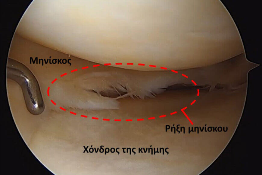 Διεγχειρητική εικόνα αρθροσκόπησης γόνατος στην οποία φαίνεται μία ρήξη μηνίσκου στην οποία θα γίνει η μερική μηνισκεκτομή