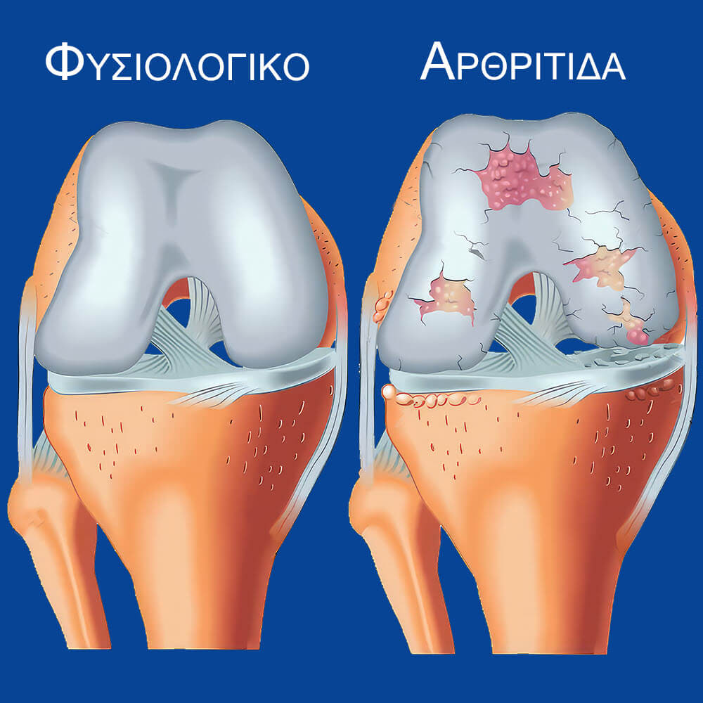 Φυσιολογικό γόνατο και γόνατο με αρθρίτιδα και κατεστραμένο αρθρικό χόνδρο, (φθορά του χόνδρου)