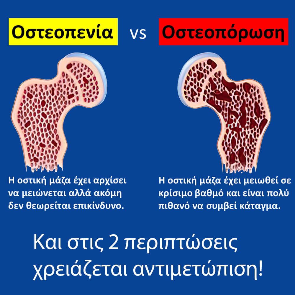 Η διαφορά μεταξύ οστεοπενίας και οστεοπόρωσης.