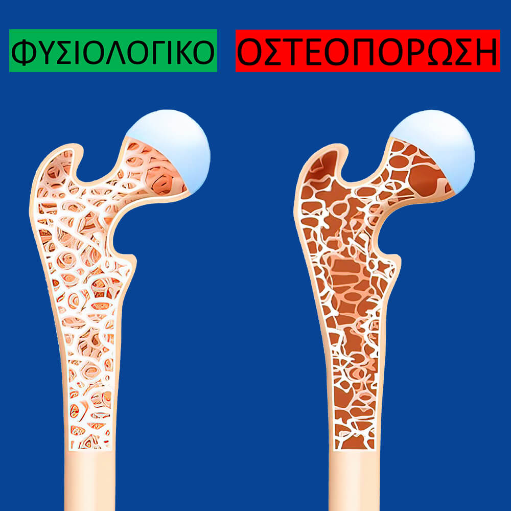 Η διαφορά μεταξύ φυσιολογικού οστού και οστεοπόρωσης είναι ότι το οστεοπορωτικό οστό έχει χαμηλή οστική πυκνότητα και είναι πιο σπογγώδες.