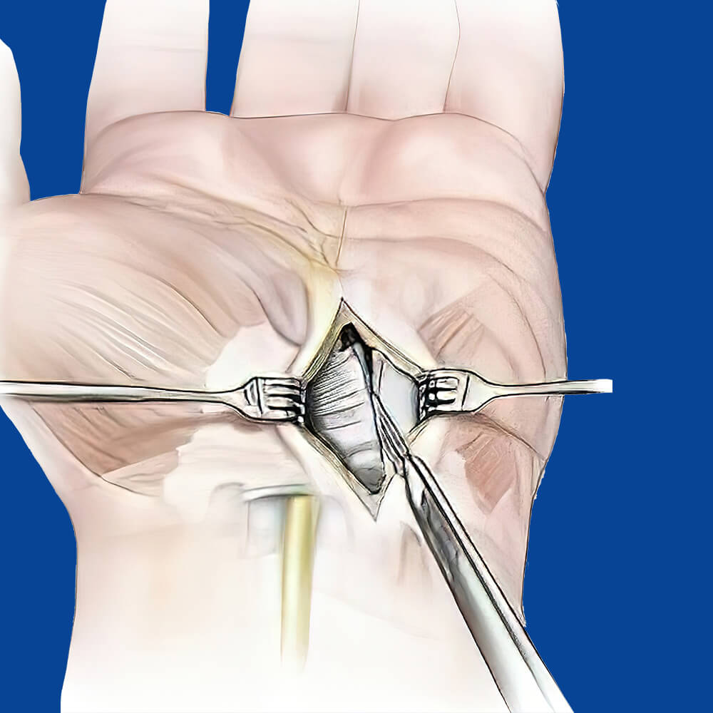 Χειρουργική διάνοιξη καρπιαίου σωλήνα με απελευθέρωση του νεύρου κόβοντας τον εγκάρσιο σύνδεσμο